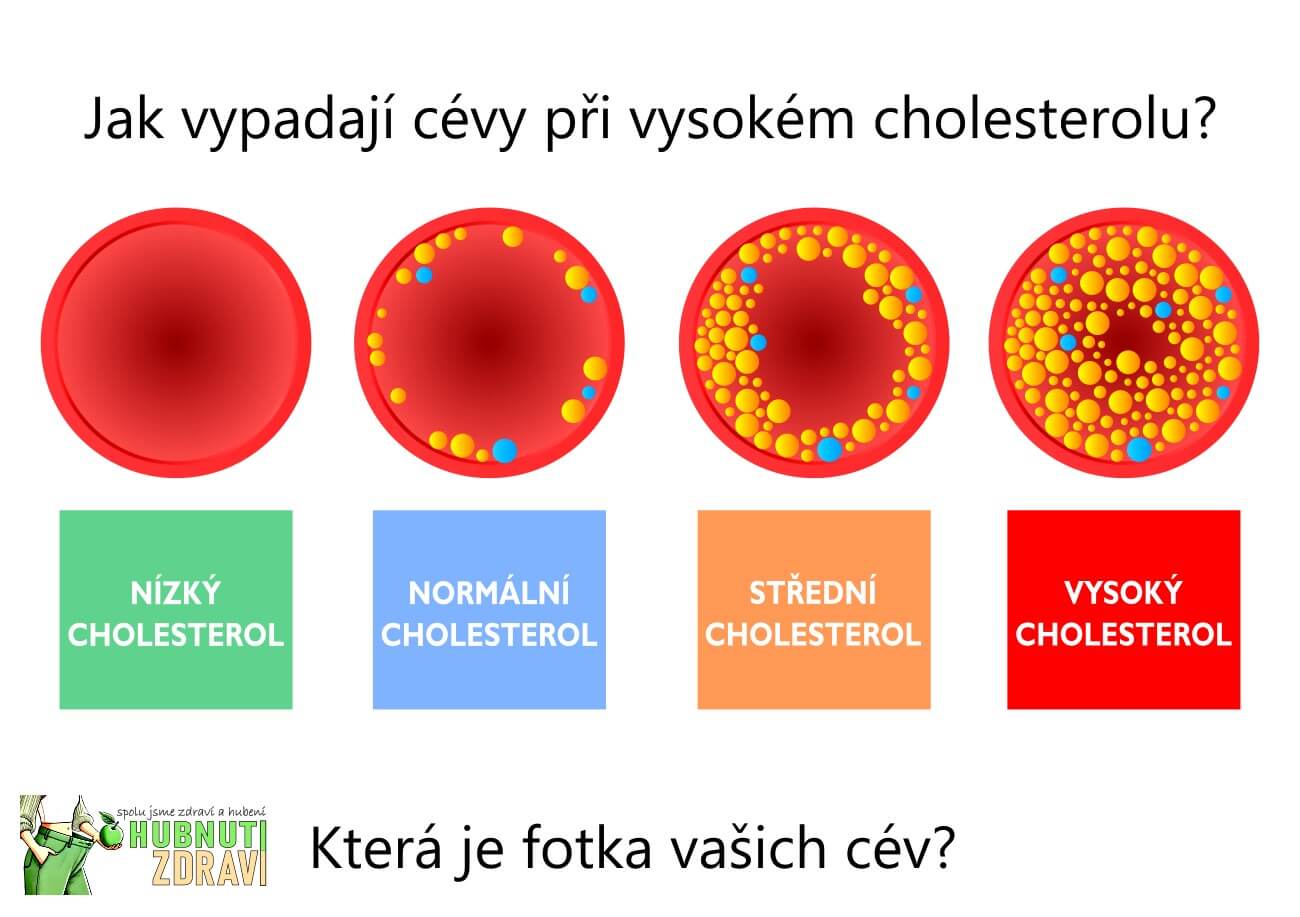 Jak vypadají cévy člověka s vysokým cholesterolem?